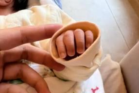 婴儿出生第四天黄疸19 出生第四天黄疸19严重吗
