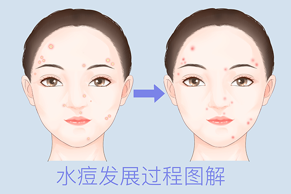 水痘会传染给别人吗 水痘的症状
